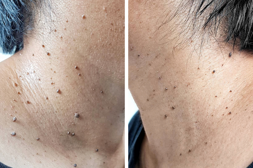 Skin tags removal in Dubai Skin tags removal in Dubai